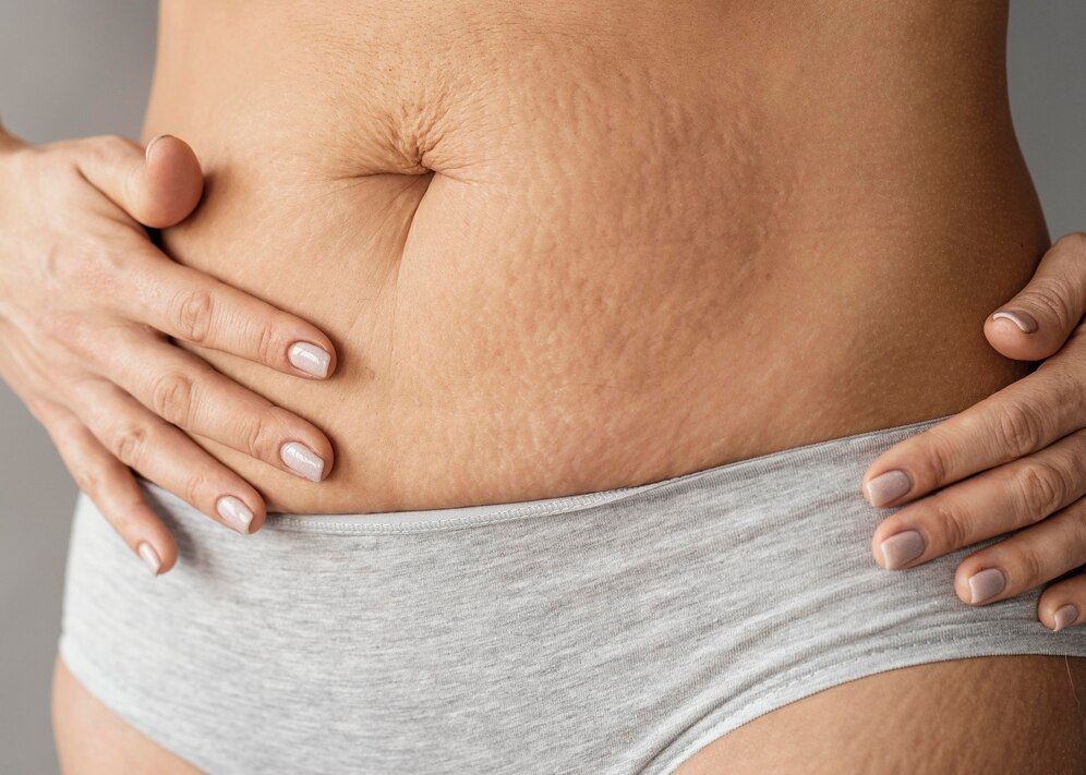 Stretch Marks Treatment in Little Elm